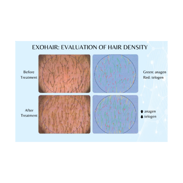 EXOGLOW Hair Exosomes (1x5ml)