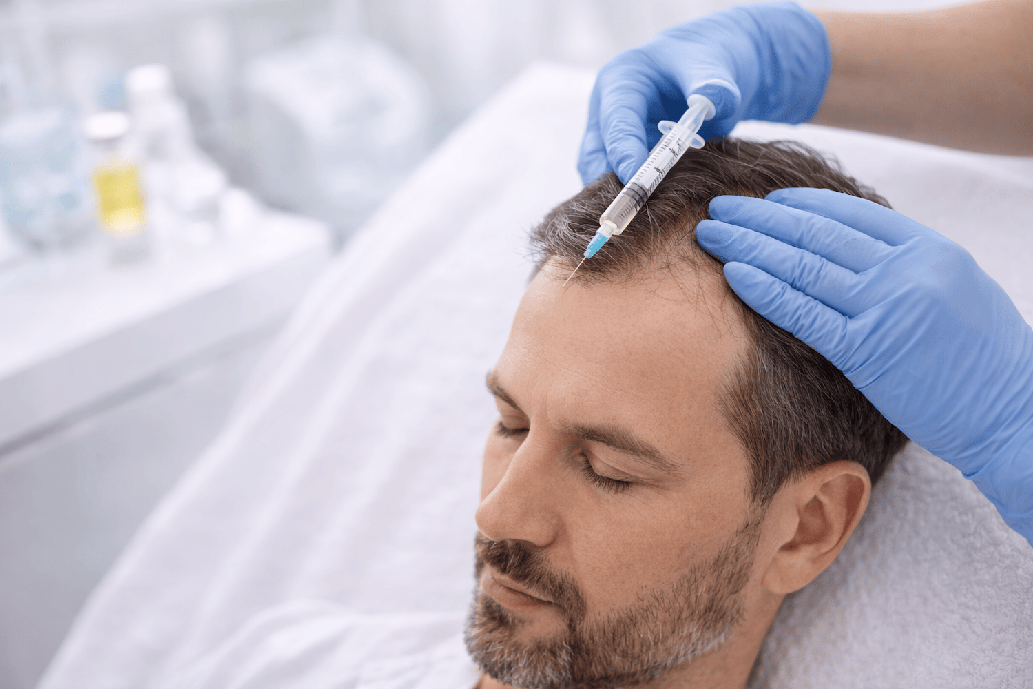 Mezoterapia skóry głowy – wypadanie włosów: efekty i protokół